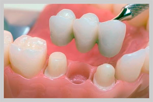 Dental crown and bridge
